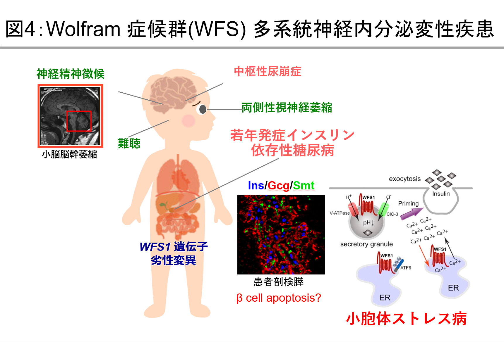 Wolfram 症候群(WFS) 多系統神経内分泌変性疾患